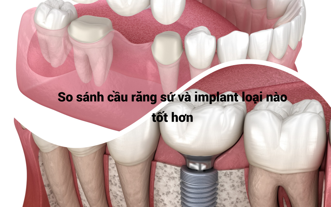 Cầu răng và Implant nên chọn phương pháp nào khi mất răng ?